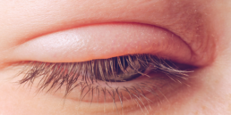 blepharitis: treatment solutions
